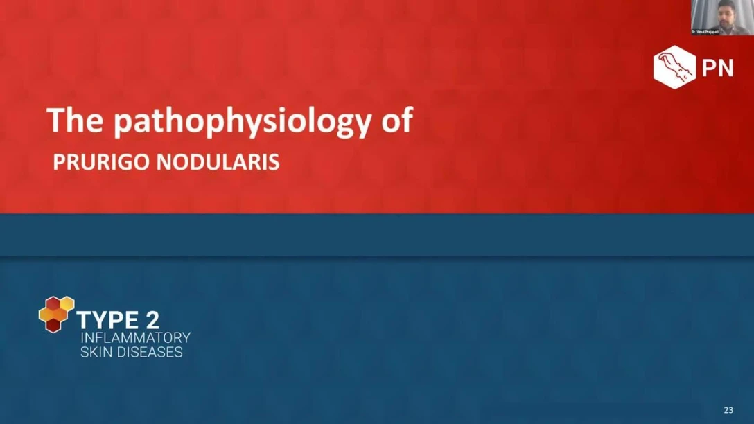 Type 2 Inflammation and Prurigo Nodularis