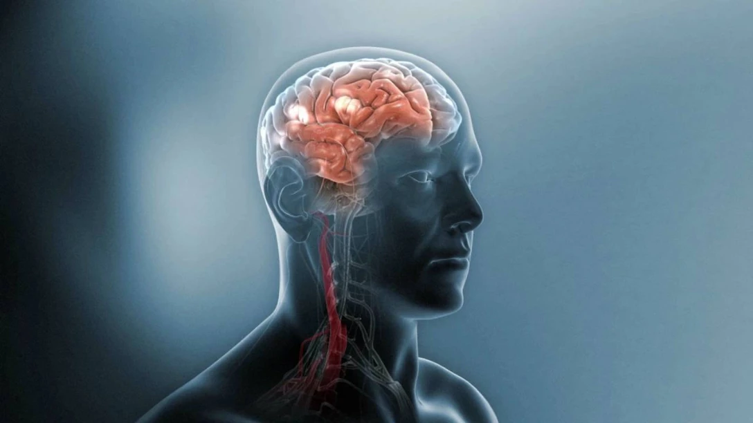 Sjukdomsprocessen vid multipel skleros (Swedish)