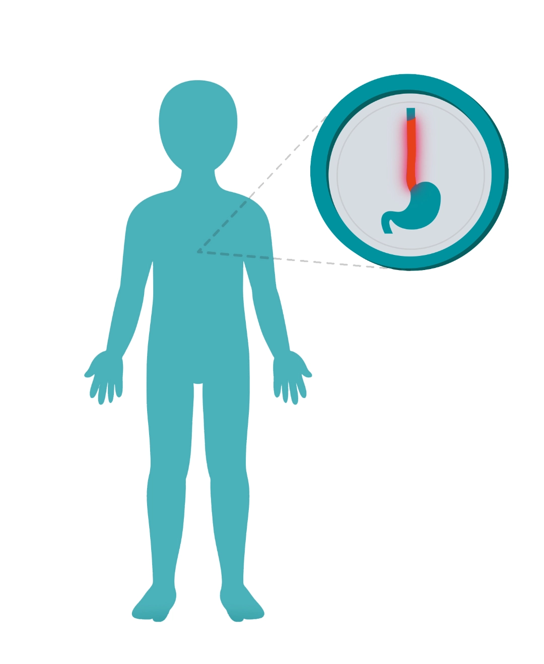 eosinophilic-esophagitis