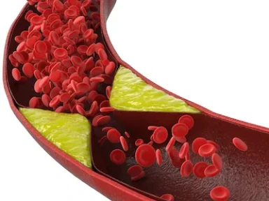 Ticagrelor vs Clopidogrel in ACS patients undergoing PCI in routine clinical practice