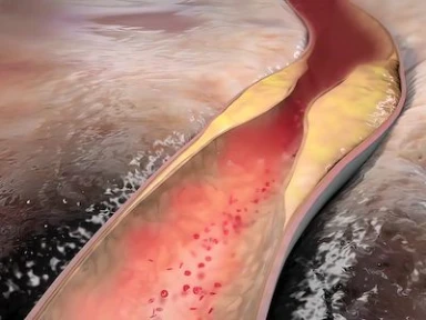 LDL-C Targets in Patients with Heterozygous Familial Hypercholesterolemia