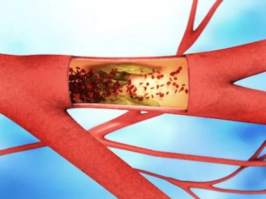 Achievement of ESC/EAS LDL-C Treatment Goals After an ACS with Statin and Alirocumab  