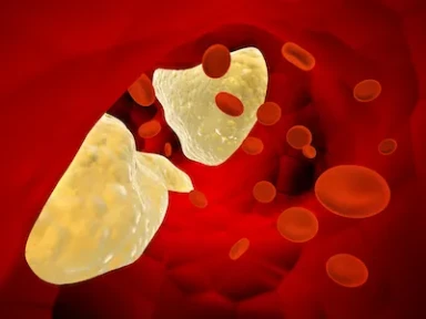 Perceptions and Barriers on the use of PCSK9 inhibitors