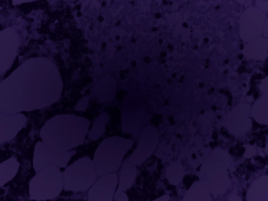 True Cost of Multiple Myeloma