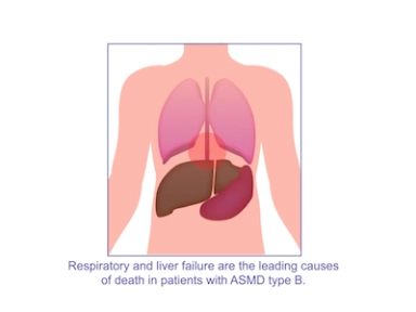 Respiratory Impairment in Acid Sphingomyelinase Deficiency (ASMD): A Case Report.