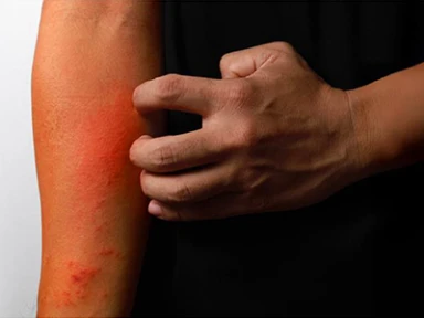 Improving Quality of Life in Patients with Uncontrolled Atopic Dermatitis (AD): Tools for Timely Identification and Treatment