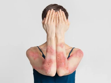 The Hidden Impact of Cumulative Life Course Impairment (CLCI) in Dermatology: An Overview