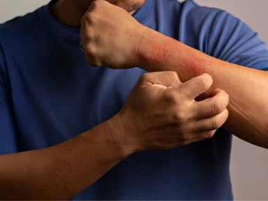 Unseen Burdens: How Cumulative Life Course Impairment (CLCI) Affects Patients with Moderate-to-Severe Atopic Dermatitis (AD)