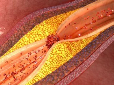 Adherence and persistence analysis in patients treated with DAPT