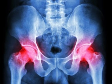 Prolonged Thromboprophylaxis with LMWH after Abdominal or Pelvic Surgery