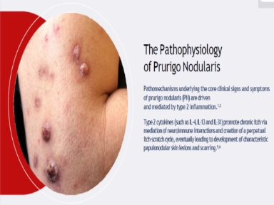 The Pathophysiology of Prurigo Nodularis