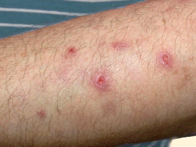 Advancing the treatment: Meeting the challenge of uncontrolled Atopic Dermatitis (AD) and Prurigo Nodularis (PN)