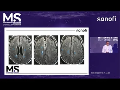 A Patient's Journey on Teriflunomide: insights into Long-Term Treatment