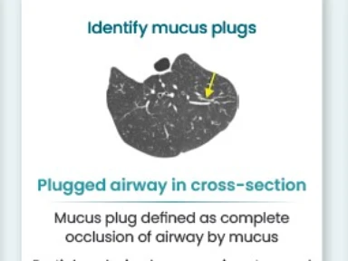 Mucus Plugging Is a Key Component of Remodeling<br /> in Asthma, Leading to Fixed Airway Obstruction