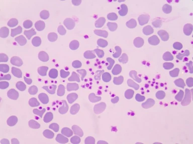 The pathophysiology of ITP stems from complex immune dysregulation drives thrombocytopenia and inflammation