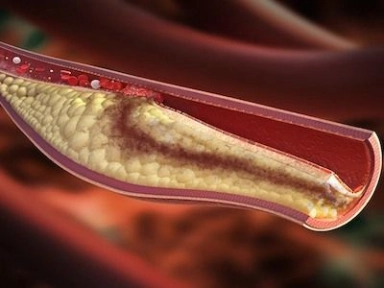 Risk factors of lower extremity DVT in patients undergone gynecological laparoscopic surgery