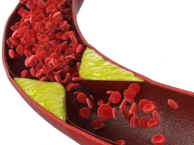 Ticagrelor vs Clopidogrel in ACS patients undergoing PCI in routine clinical practice