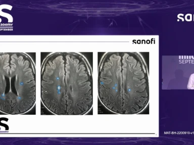 A Patient's Journey on Teriflunomide: insights into Long-Term Treatment