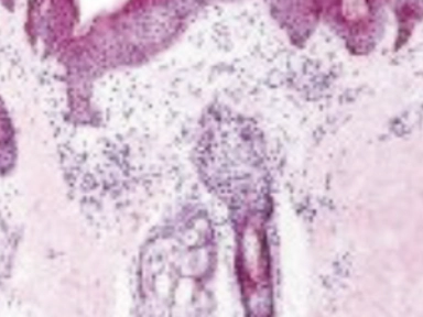 Scoring Atopic Dermatitis (SCORAD) Calculator (0.9.0)