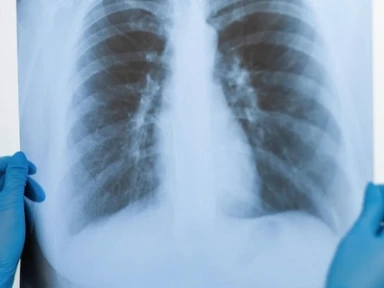 Ash 2019 Guidelines for Surgical Prophylaxis