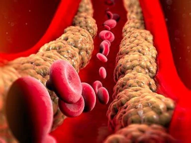 Relationship Between LDL-C LLTs and Risk of Stroke