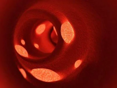 Post Thrombotic Syndrome in Women