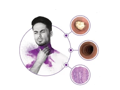 Importance of assessing key disease domains in EOE