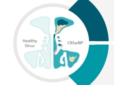 IL-4 and IL-13 are key and central cytokines with unique and overlapping roles contributing to the pathophysiology of CRSwNP