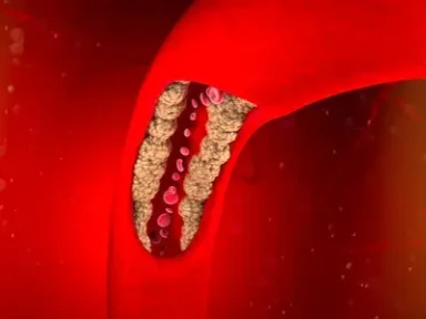 Evaluation of lipid management following ACS