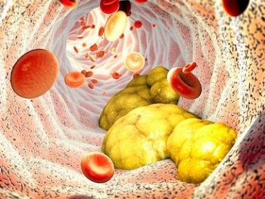 Lp(a) as ASCVD risk factor