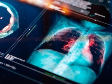Safety profile of preoperative administration of low-molecular-weight heparin for Lung Cancer population
