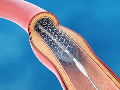 Caprini Score Responses to Prevent VTE in Patients Undergoing Varicose Vein Surgery