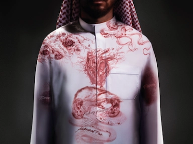 Acquired Thrombotic Thrombocytopenic Purpura (aTTP)