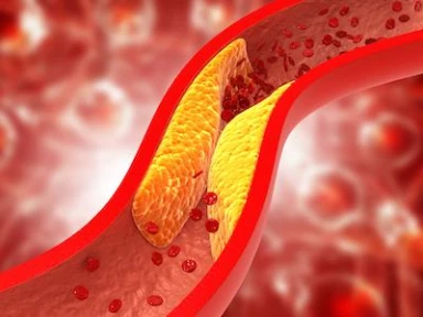 Hypercholesterolemia Treatment Patterns and Lipid Target in ACS Patients: HYDRA-ACS Registry