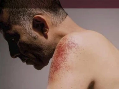 Signs and symptoms of aTTP