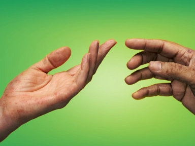 Hand och fot atopisk dermatit