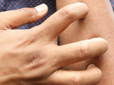 The Long-Term Impact of Early-Onset Atopic Dermatitis