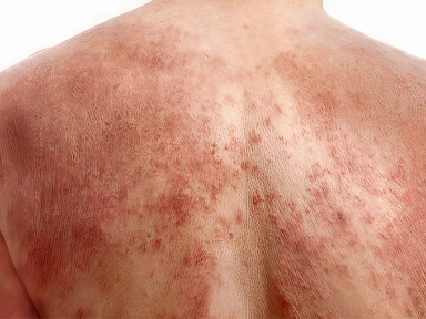 Exploring the Unique Characteristics of Atopic Dermatitis (AD) and Prurigo Nodularis (PN)