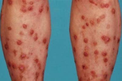 Prurigo Nodularis