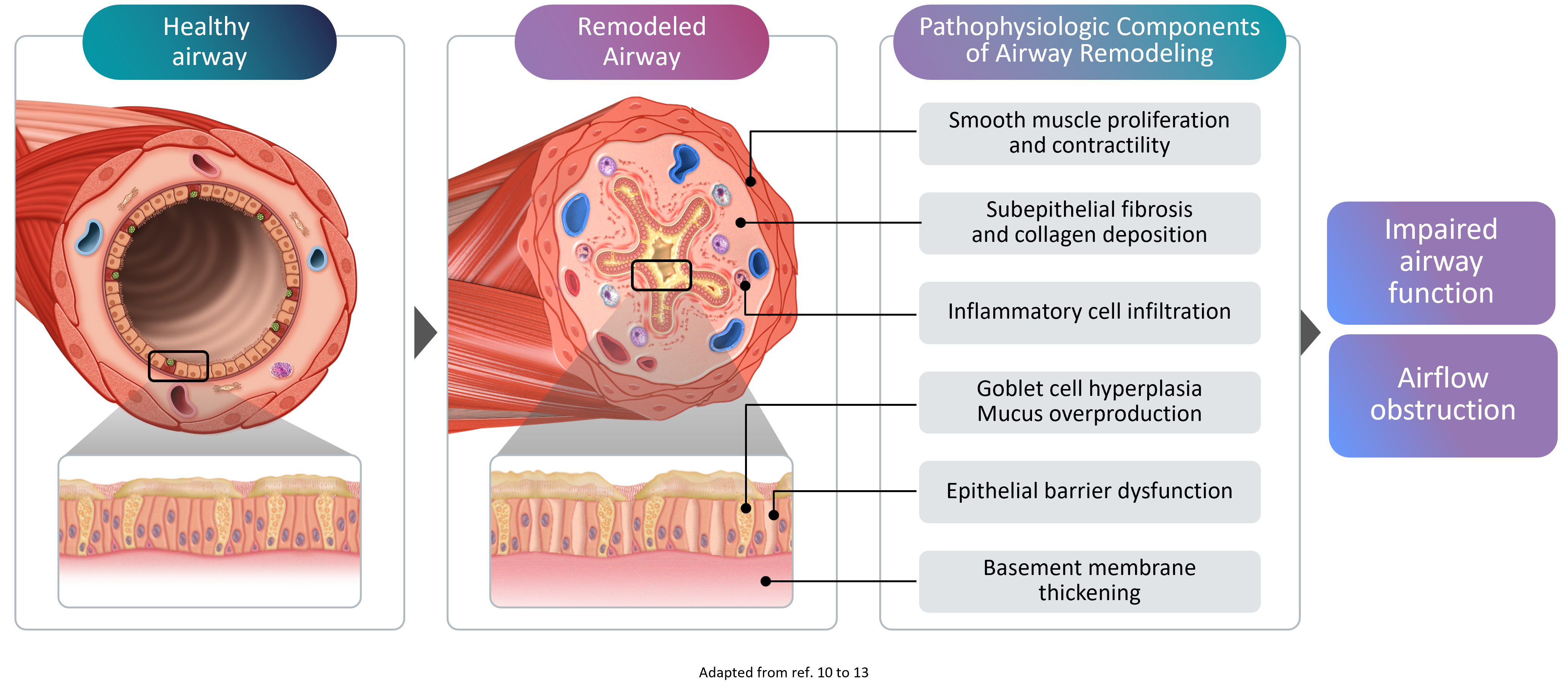 Remodeling in asthma comprises structural changes to the airways