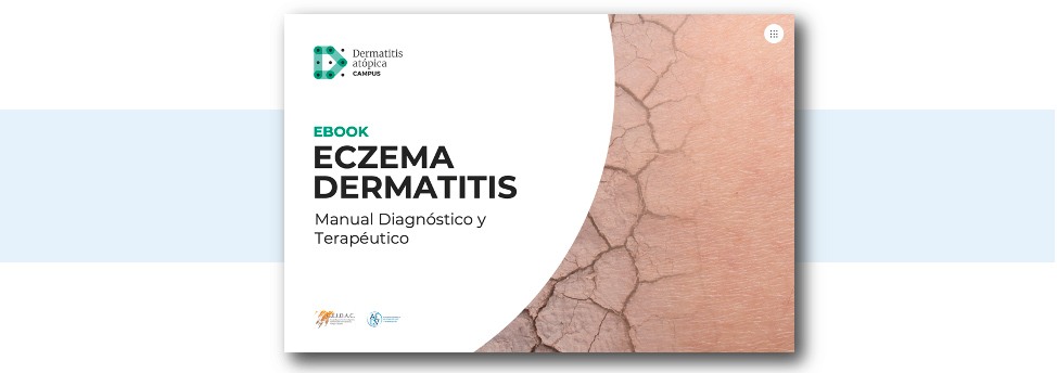 Ebook Eczema Dermatitis Manual Diagnóstico Y Terapéutico Campus