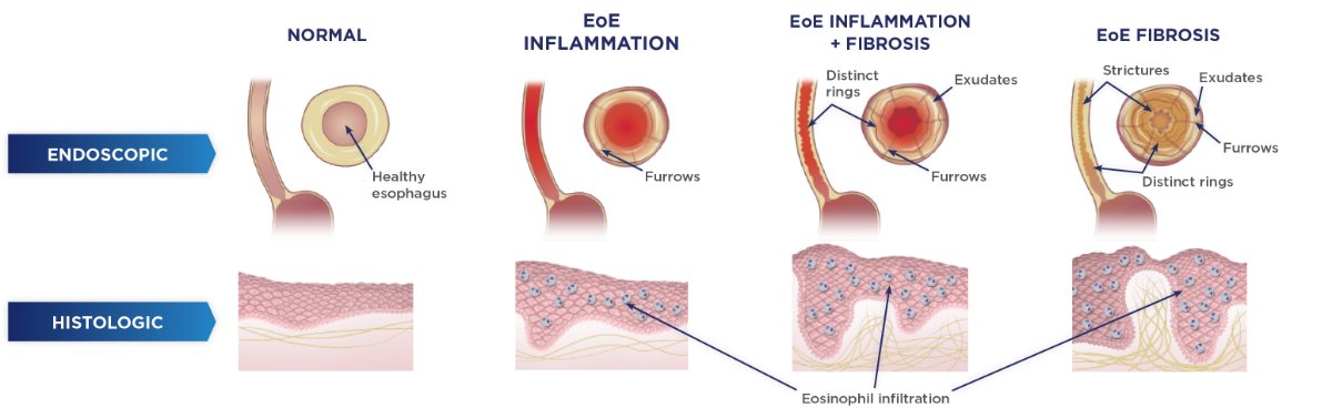 Understanding eosinophilic esophagitis (EoE)