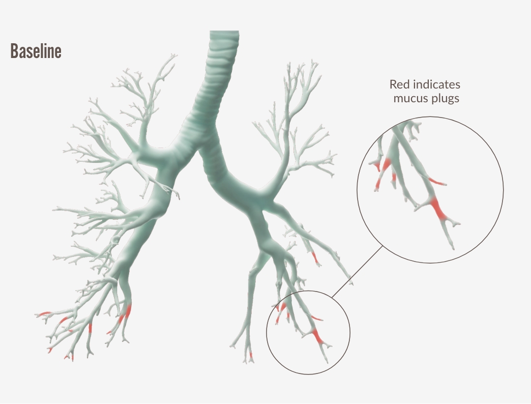 Mucus Plugs_Baseline